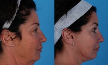 Dr. Heffelfinger performed a face and neck lift as well as full face CO2 laser resurfacing. Patient is shown at one year post surgery.