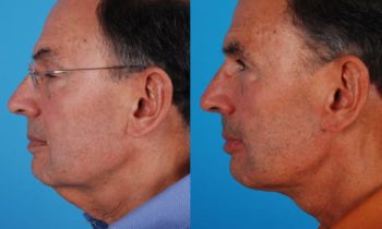 Patient presented for submental necklift to reduce the appearance of lower face and neck sagging including reducing the uncomfortable turkey waddle under the chin.