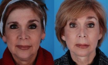 Dr. Heffelfinger performed and full face and neck lift
