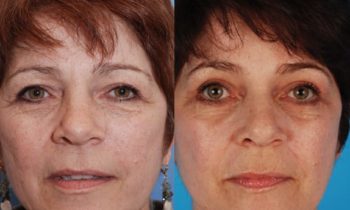 upper and lower eyelid surgery before and after