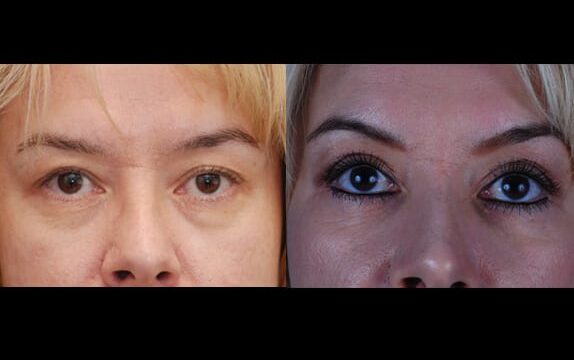 Patient photo upper and lower eyelid surgery