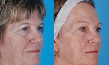 aging face and sun damage with drooping eyelids and redundant tissue around the eyes