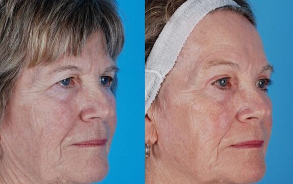 aging face and sun damage with drooping eyelids and redundant tissue around the eyes