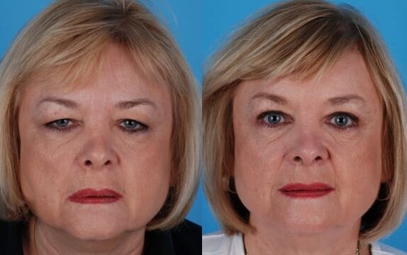 Dr. Krein performed endoscopic browlift with upper blepharoplasty