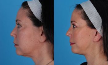 Before and After laser resurfacing