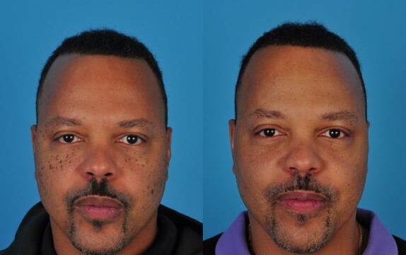 Before and After laser-resurfacing radiosurgery man