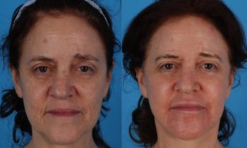 Before and After facelift and necklift surgery combined with CO2 laser resurfacing to reduce or eliminate age spots, fine lines and wrinkles as well as to boost collagen production