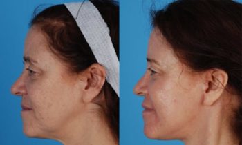 Before and After facelift and necklift surgery combined with CO2 laser resurfacing to reduce or eliminate age spots, fine lines and wrinkles as well as to boost collagen production