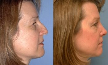 Before and After rhinoplasty severe dorsal hump