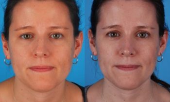 Before and After Twisted nose deformity repair and rhinoplasty