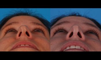 Before and After rhinoplasty twisted nose
