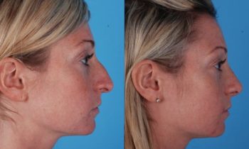 Before and After rhinoplasty Dr. Heffelfinger