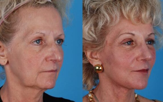 Before and After Nose Job fair skin