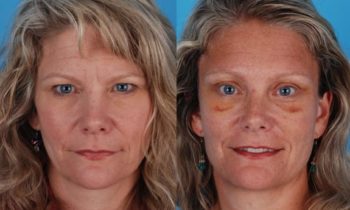 Before and After blepharoplasty