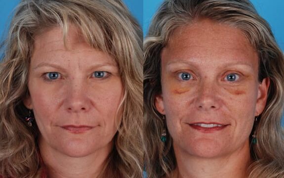 Before and After blepharoplasty