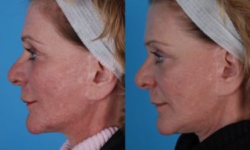 Before and After Laser Resurfacing