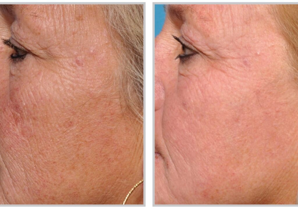 Sciton Joule X Laser Before and After