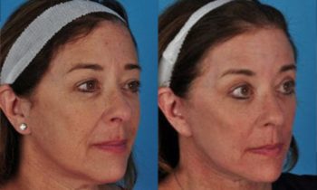 facelift-2-600x437