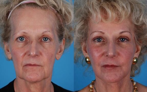 Jefferson Facial Plastics rhinoplasty before and after