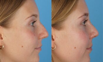 Jefferson Facial Plastics rhinoplasty before and after man 2