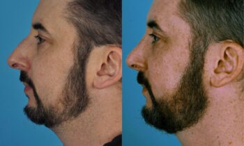 Jefferson Facial Plastics rhinoplasty before and after man 2