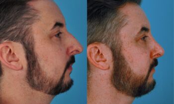 Jefferson Facial Plastics rhinoplasty before and after man1
