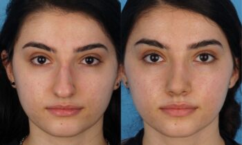 Jefferson Facial Plastics rhinoplasty before and after c2