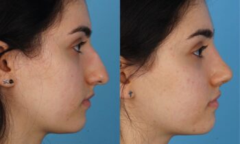 Jefferson Facial Plastics rhinoplasty before and after c1