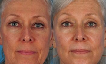 Jefferson Facial Plastics facelift before and after older 2