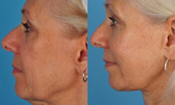 Jefferson Facial Plastics facelift before and after older