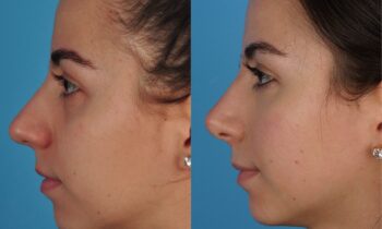 Jefferson Facial Plastics rhinoplasty before and after e4