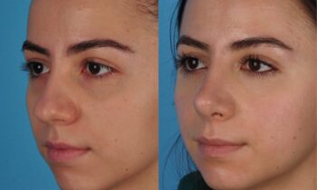 Jefferson Facial Plastics rhinoplasty before and after e3