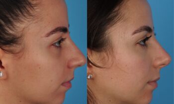 Jefferson Facial Plastics rhinoplasty before and after e2