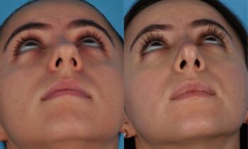 Jefferson Facial Plastics rhinoplasty before and after e