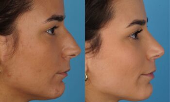 Jefferson Facial Plastics rhinoplasty before and after f
