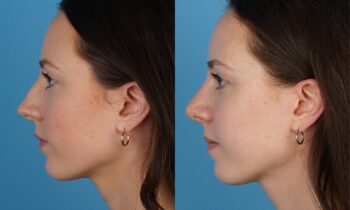 Jefferson Facial Plastics rhinoplasty before and after j2
