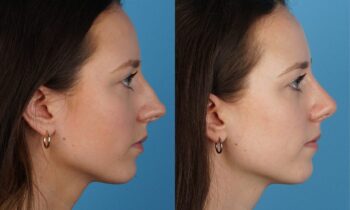 Jefferson Facial Plastics rhinoplasty before and after j