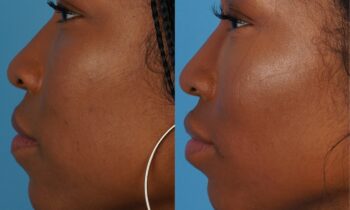 Jefferson Facial Plastics lip plump