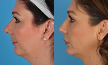 Jefferson Facial Plastics chin implant before and after 2