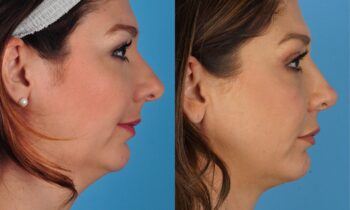 Jefferson Facial Plastics chin implant before and after