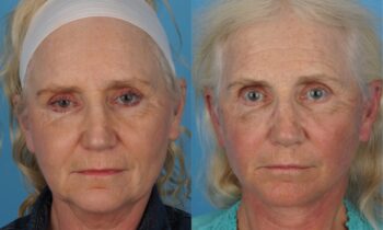 Jefferson Facial Plastics facelift before and after 2