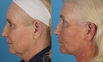 Jefferson Facial Plastics facelift l before and after