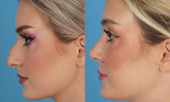 Jefferson Facial Plastics rhinoplasty before and after m2