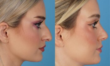 Jefferson Facial Plastics rhinoplasty before and after m