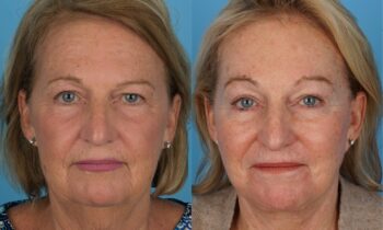 Jefferson Facial Plastics pf facelift