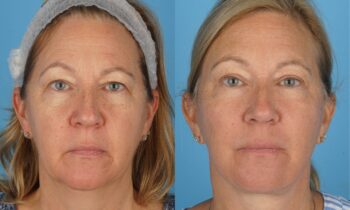 Injectables 10.1