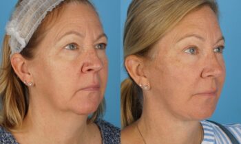 Injectables 10.3