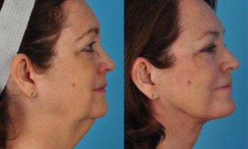 Injectables 6.1