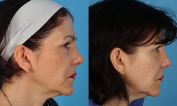 Laser & injectables 11.3