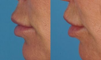 Lip Filler 1